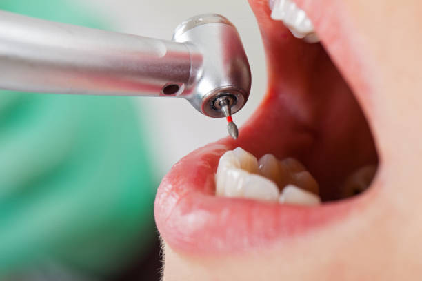 Teeth Whitening in IA